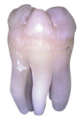 Extra Root Md Third Molar.jpg